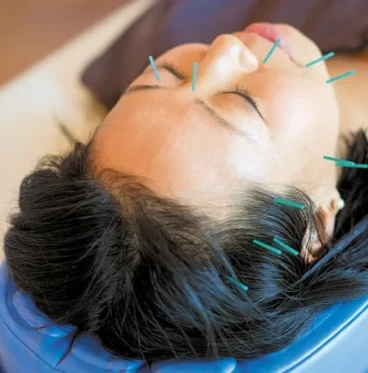 Imagem Craniopuntura de Yamamoto