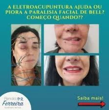 Imagem Eletroacupuntura